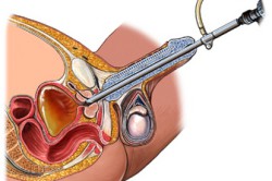 Трансуретральная резекция простаты Трансуретральная резекция простаты