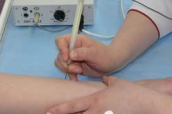 Прижигание паппиломы Прижигание паппиломы