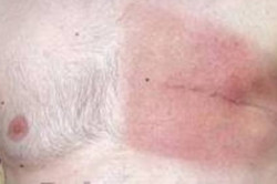 Удаление молочной железы у мужчины Удаление молочной железы у мужчины