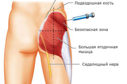 Схема введения препарата внутримышечно Схема введения препарата внутримышечно