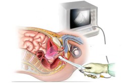 Трансректальное УЗИ Трансректальное УЗИ