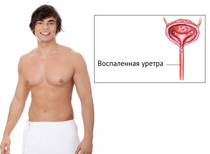 Уретрит Уретрит
