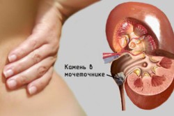 Обострение мочекаменной болезни Обострение мочекаменной болезни