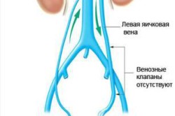 Варикоцеле Варикоцеле