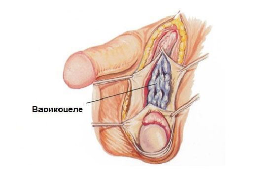 Варикоцеле Варикоцеле