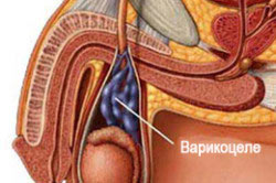 Варикоцеле Варикоцеле