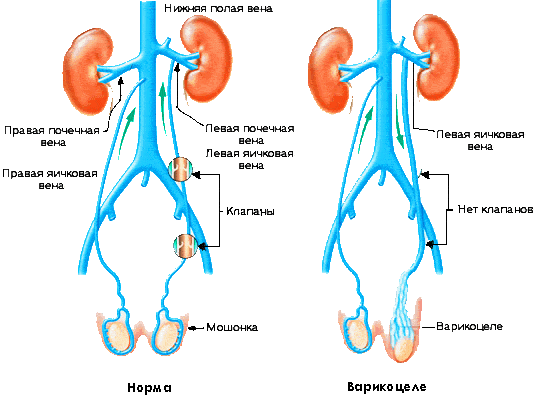 Варикоцеле у мужчин Варикоцеле у мужчин