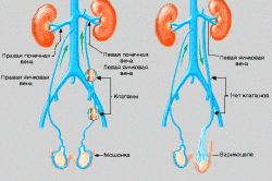 Варикоцеле Варикоцеле
