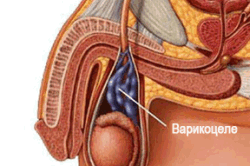 Заболевание варикоцеле