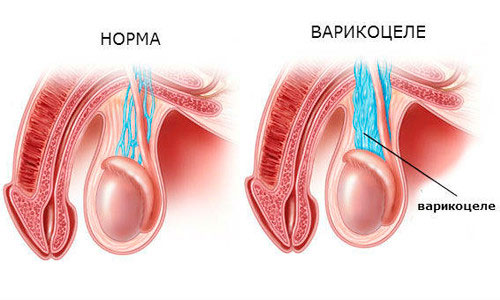 Варикоцеле Варикоцеле