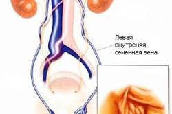 Варикоцеле Варикоцеле