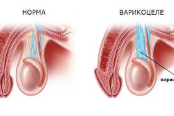 Варикоцеле диагностируется при помощи УЗИ Варикоцеле диагностируется при помощи УЗИ