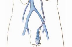 Варикоцеле