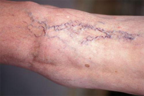 Варикозное расширение вен малого таза Варикозное расширение вен малого таза