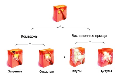 Виды прыщей Виды прыщей