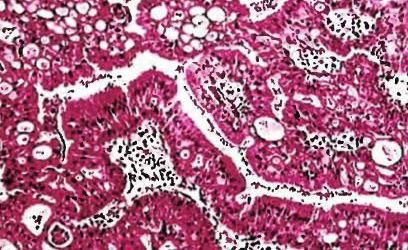 Вирус папилломы под микроскопом