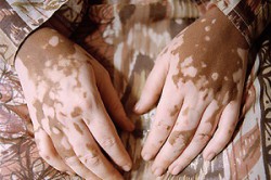 Пигментные пятна вследствие болезни витилиго Пигментные пятна вследствие болезни витилиго