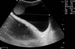 Водянка яичка на узи органов мошонки Водянка яичка на узи органов мошонки