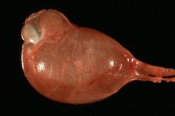 Водянка яичек Водянка яичек