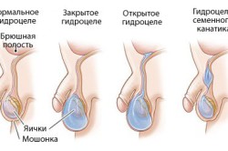 Виды водянки яичка Виды водянки яичка