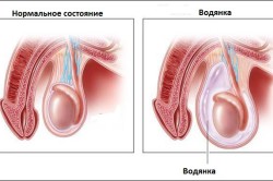 Водянка яичка является распространенным осложнением после операции Водянка яичка является распространенным осложнением после операции