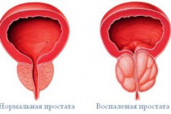 Воспаление простаты Воспаление простаты