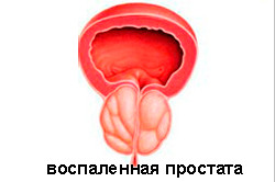Воспаленная простата Воспаленная простата