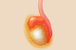 Воспаленный придаток яичка Воспаленный придаток яичка