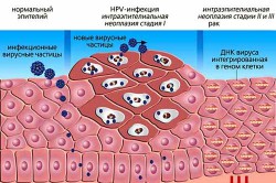 Фазы развития онкогенного ВПЧ Фазы развития онкогенного ВПЧ