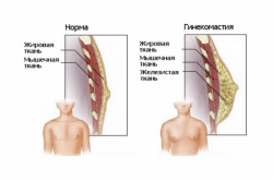 Грудные железы у мужчин (норма и гинекомастия) Грудные железы у мужчин (норма и гинекомастия)