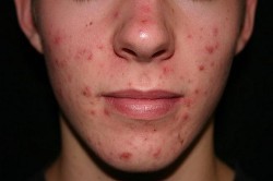 Угревая сыпь