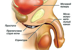 Стриктура уретры Стриктура уретры