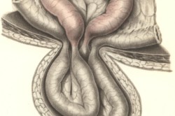 Ущемленная грыжа Ущемленная грыжа