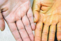 Желтуха у мужчин Желтуха у мужчин