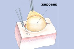Вид жировика Вид жировика